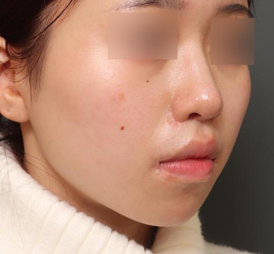 20代女性の人中短縮（リップリフト） After 症例写真