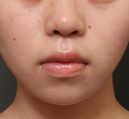 20代女性の人中短縮（リップリフト） Before 症例写真