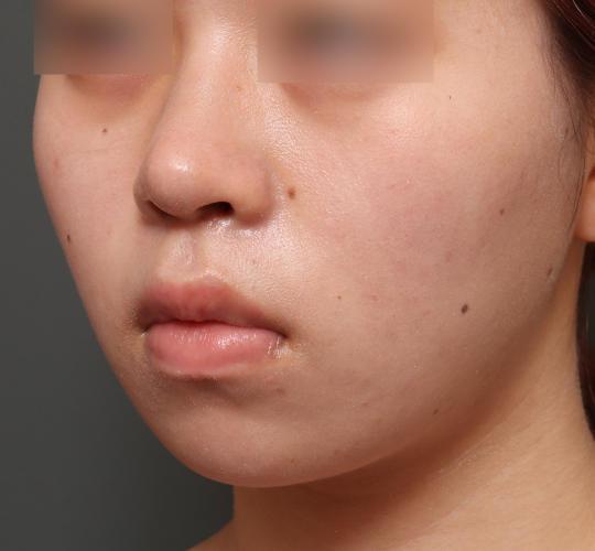 20代女性の人中短縮(リップリフト) Before 症例写真