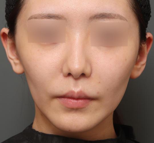 20代女性の人中短縮(リップリフト) After 症例写真