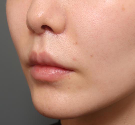 20代女性の人中短縮（リップリフト） After 症例写真