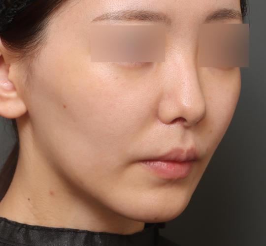 20代女性の人中短縮（リップリフト） After 症例写真