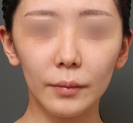 20代女性の人中短縮(リップリフト) Before 症例写真