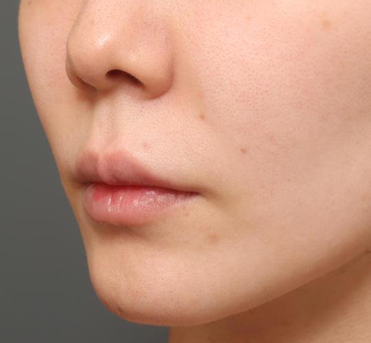 20代女性の人中短縮（リップリフト） Before 症例写真
