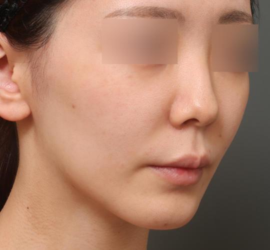 20代女性の人中短縮（リップリフト） Before 症例写真