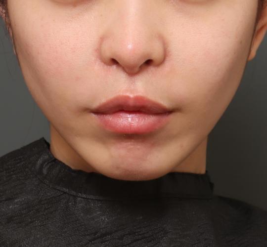 20代女性の人中短縮(リップリフト) After 症例写真