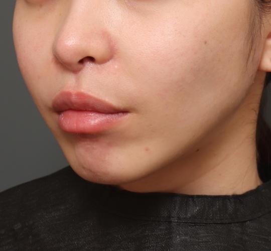 20代女性の人中短縮（リップリフト） After 症例写真