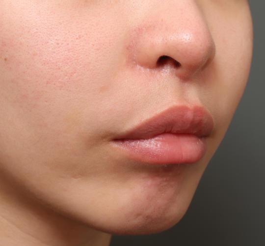 20代女性の人中短縮（リップリフト） After 症例写真