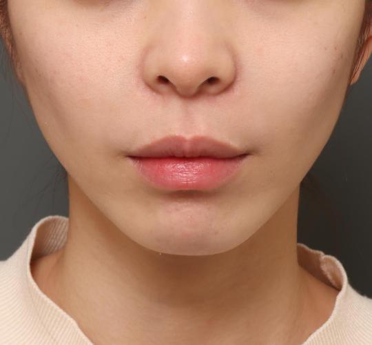 20代女性の人中短縮(リップリフト) Before 症例写真