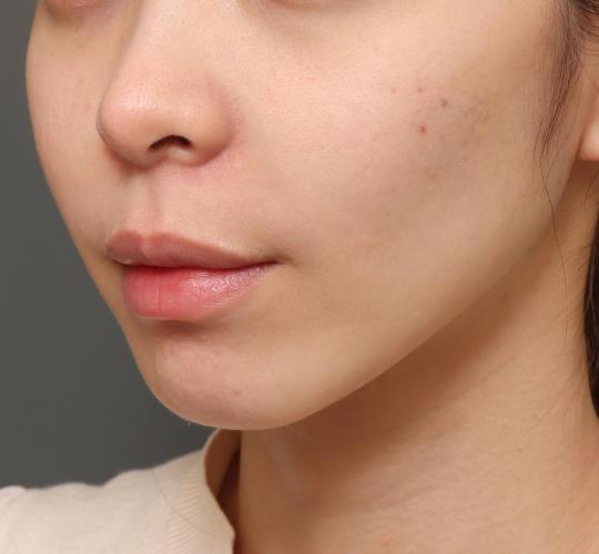20代女性の人中短縮（リップリフト） Before 症例写真