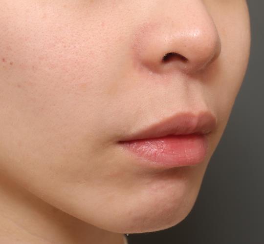 20代女性の人中短縮（リップリフト） Before 症例写真