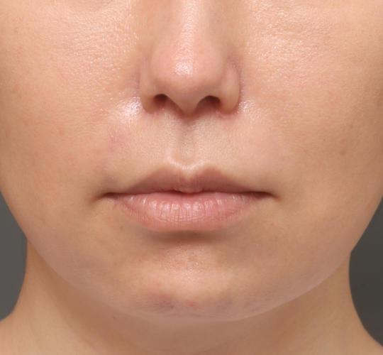 40代女性の人中短縮(リップリフト) After 症例写真