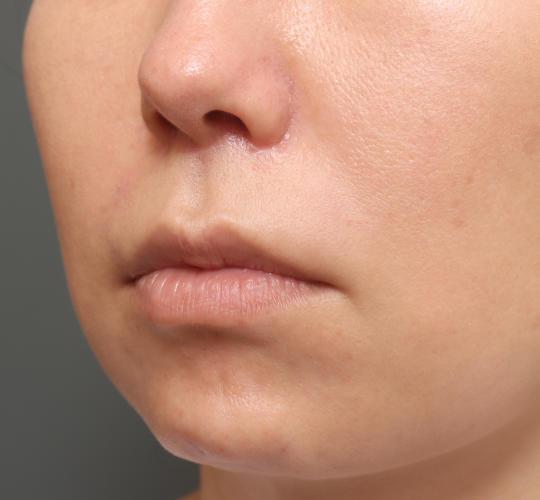 40代女性の人中短縮(リップリフト) After 症例写真