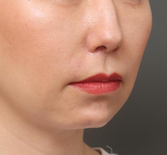 40代女性の人中短縮(リップリフト) After 症例写真
