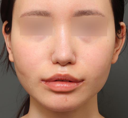 10代女性の人中短縮(リップリフト) After 症例写真