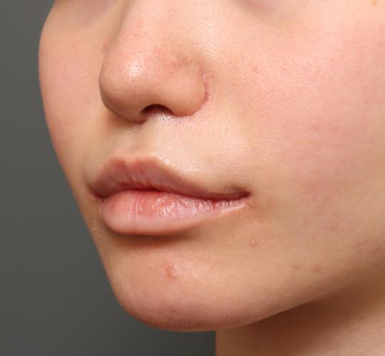 10代女性の鼻翼縮小(小鼻縮小) After 症例写真