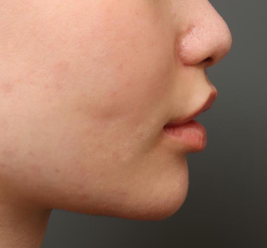 10代女性の鼻翼縮小(小鼻縮小) After 症例写真