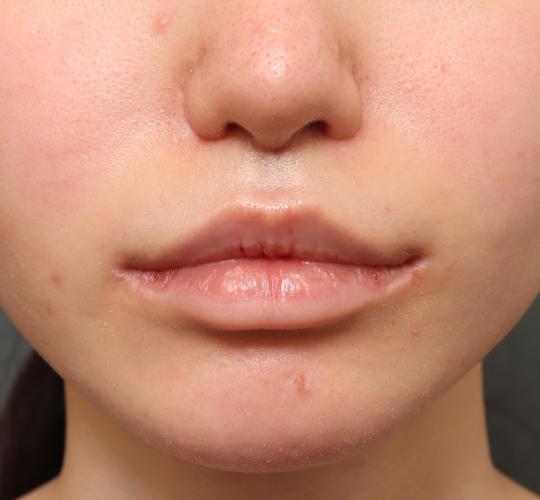 10代女性の鼻翼縮小(小鼻縮小) After 症例写真