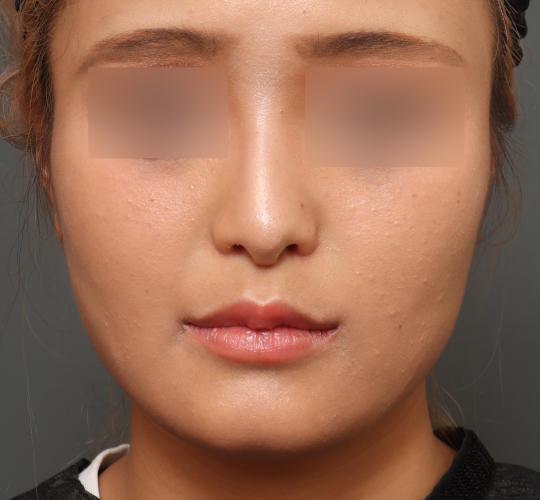 20代女性の鼻翼縮小（小鼻縮小） After 症例写真