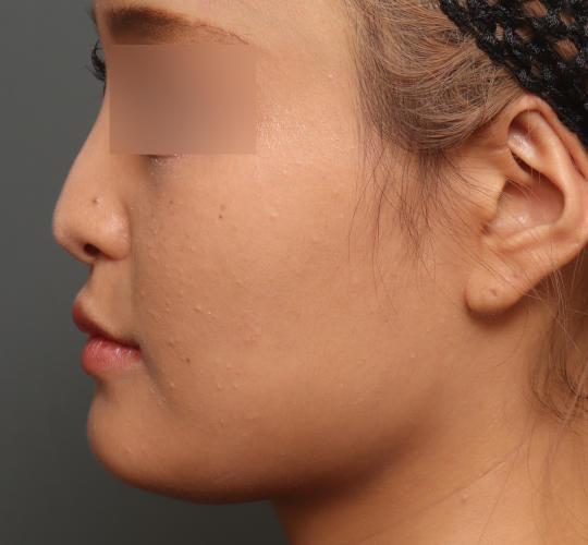 20代女性の鼻翼縮小（小鼻縮小） After 症例写真