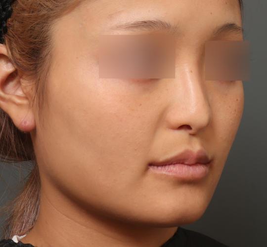 20代女性の鼻翼縮小（小鼻縮小） After 症例写真