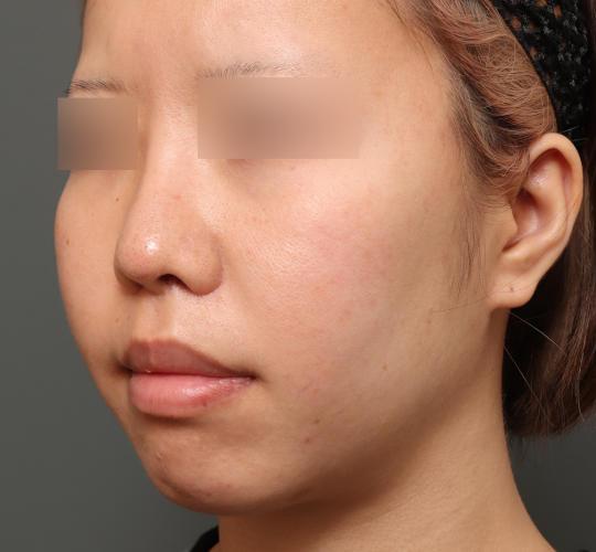 20代女性の人中短縮（リップリフト） After 症例写真