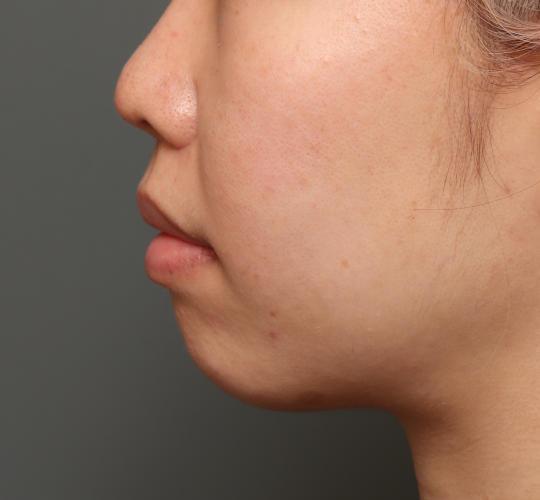 20代女性の人中短縮（リップリフト） After 症例写真