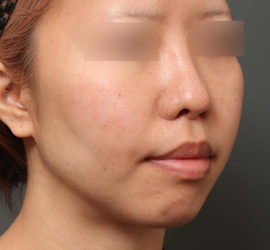 20代女性の人中短縮(リップリフト) After 症例写真