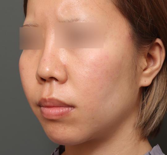 20代女性の人中短縮（リップリフト） Before 症例写真