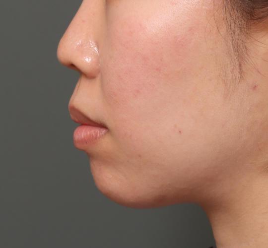 20代女性の人中短縮（リップリフト） Before 症例写真