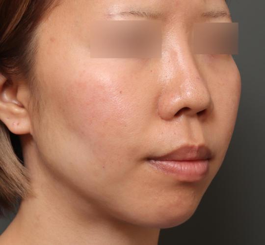 20代女性の人中短縮(リップリフト) Before 症例写真