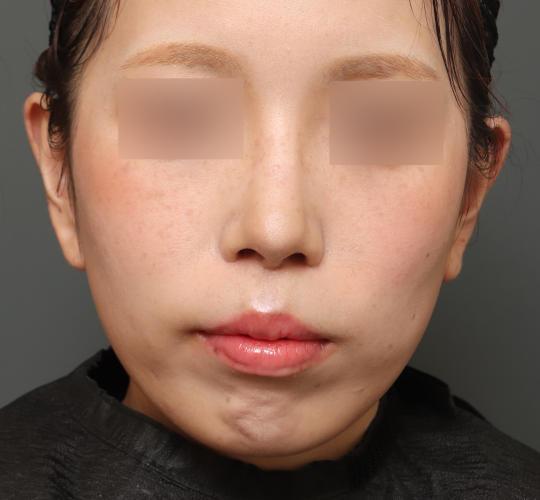 30代女性の人中短縮(リップリフト) After 症例写真