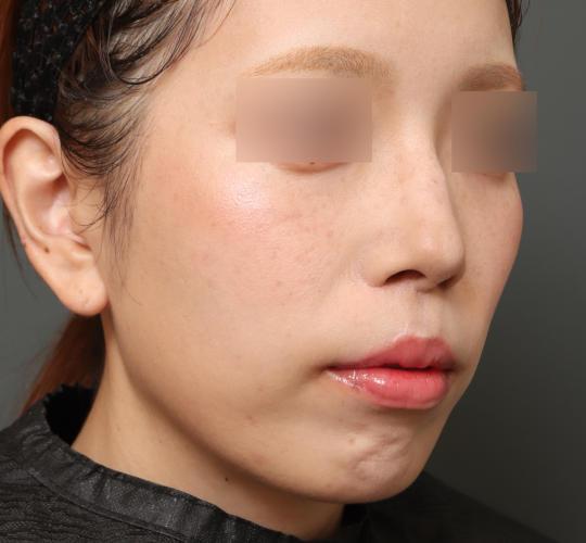 30代女性の人中短縮（リップリフト） After 症例写真