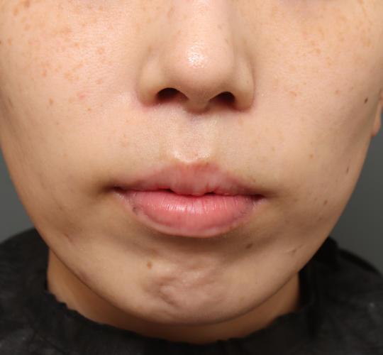 30代女性の人中短縮（リップリフト） After 症例写真
