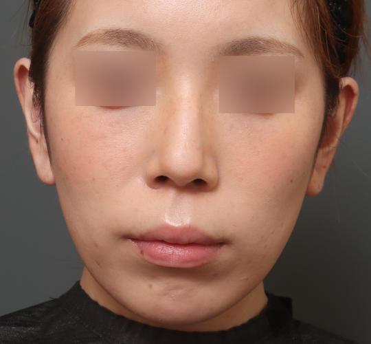 30代女性の人中短縮(リップリフト) Before 症例写真
