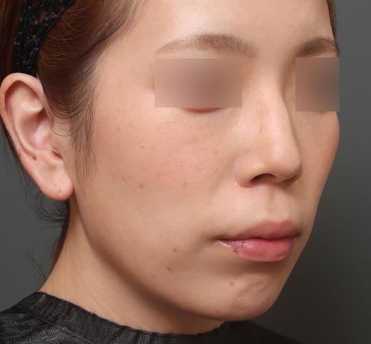 30代女性の人中短縮（リップリフト） Before 症例写真