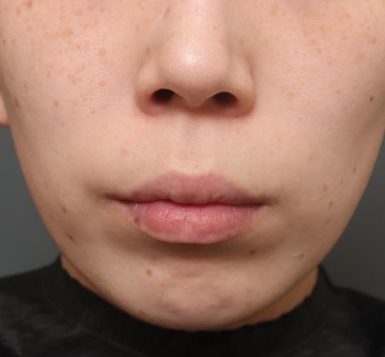 30代女性の人中短縮（リップリフト） Before 症例写真