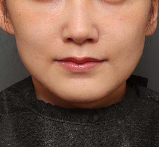20代女性の人中短縮(リップリフト) After 症例写真