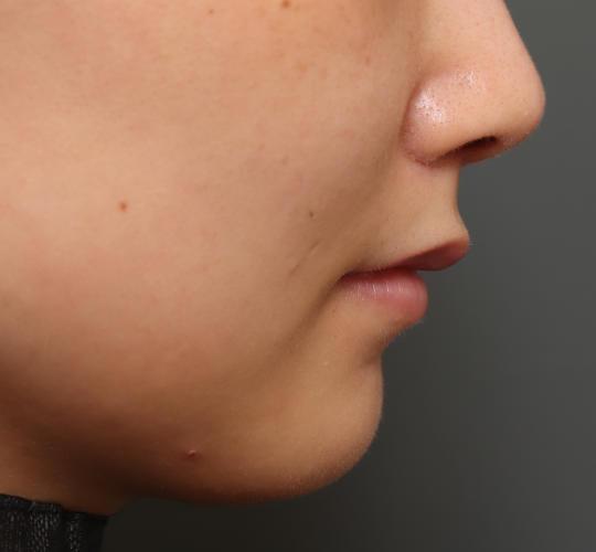 20代女性の人中短縮(リップリフト) After 症例写真