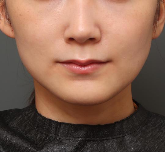 20代女性の人中短縮(リップリフト) Before 症例写真