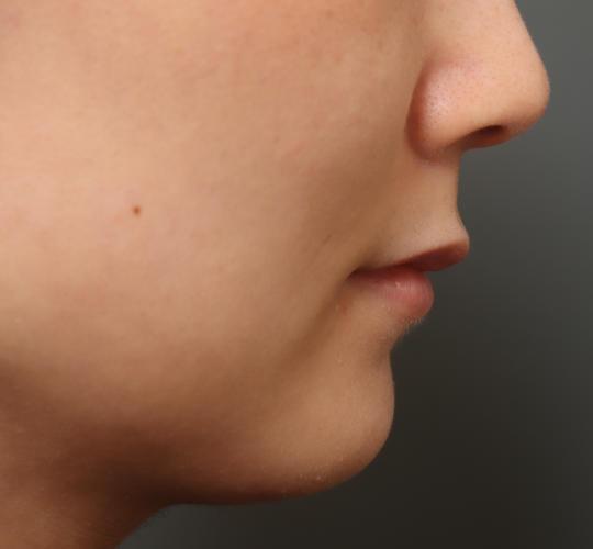 20代女性の人中短縮(リップリフト) Before 症例写真