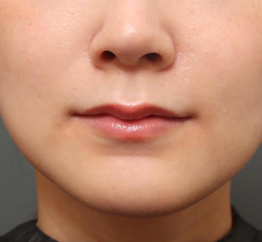 20代女性の人中短縮(リップリフト) Before 症例写真
