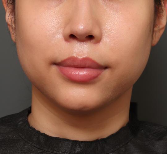 30代女性の人中短縮(リップリフト) After 症例写真