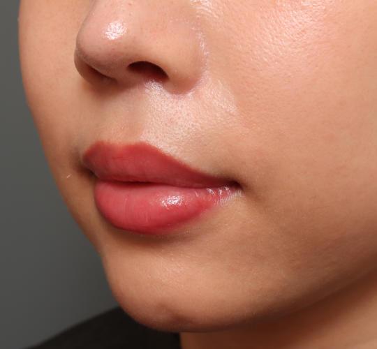 30代女性の人中短縮（リップリフト） After 症例写真
