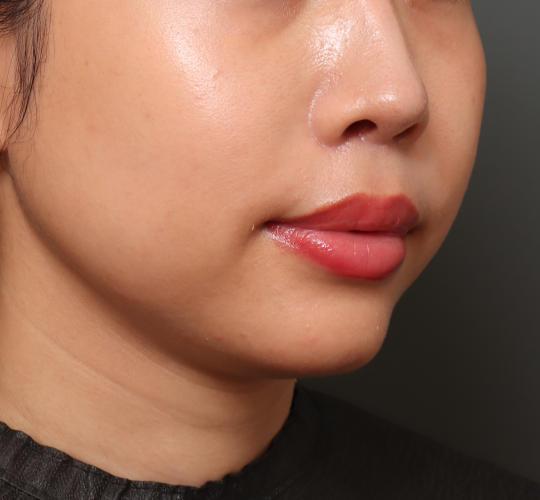 30代女性の人中短縮（リップリフト） After 症例写真