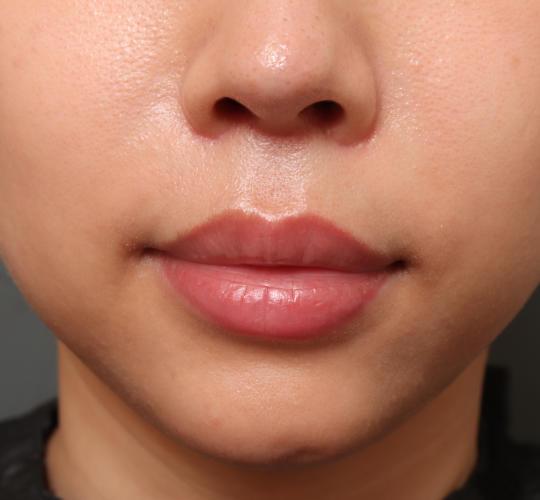 30代女性の人中短縮（リップリフト） After 症例写真