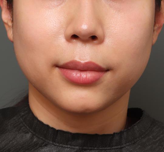 30代女性の人中短縮(リップリフト) Before 症例写真