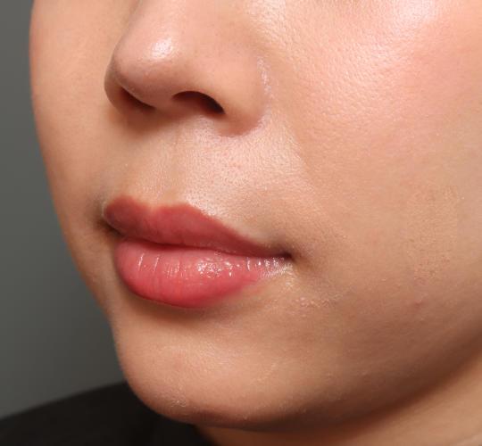 30代女性の人中短縮（リップリフト） Before 症例写真