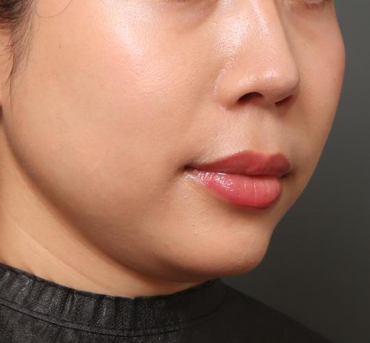 30代女性の人中短縮（リップリフト） Before 症例写真