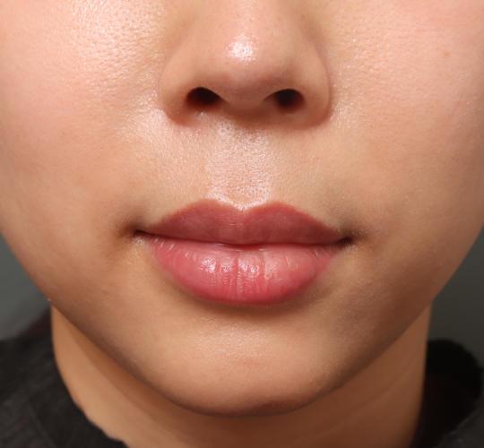 30代女性の人中短縮（リップリフト） Before 症例写真